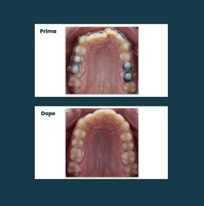 Ortodonzia Aufiero Caso 08